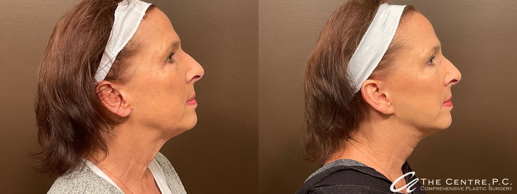 Before and after Featured Cases case 13975 - Angle 3