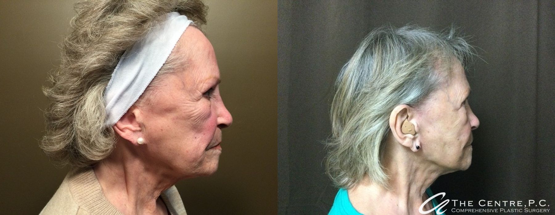 Before and after Facelift case 9965 - Angle 2