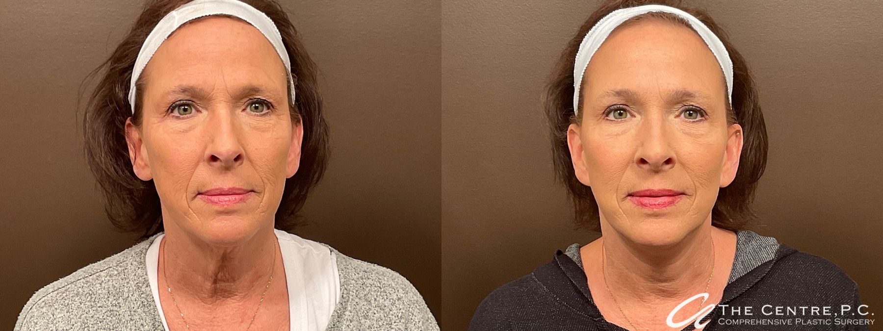 Before and after Featured Cases case 13975