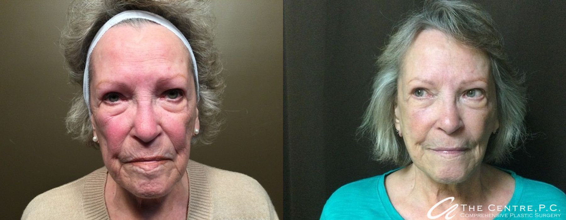 Before and after Facelift case 9965