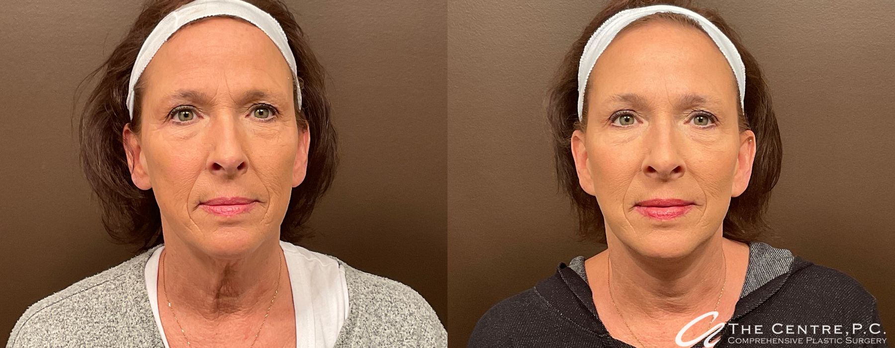 Facelift - Case 3449