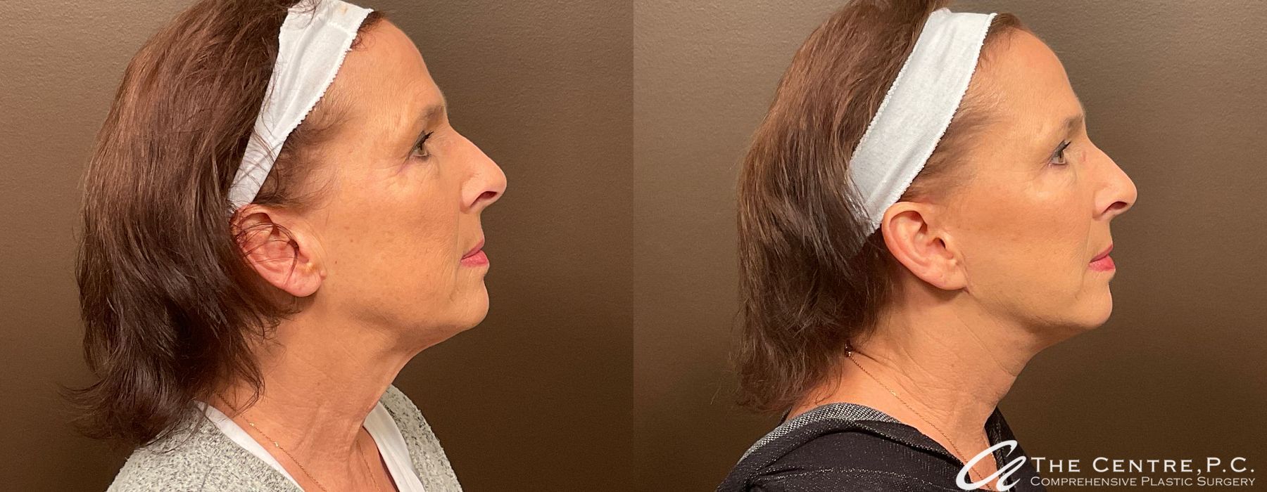 Facelift - Thumbnail 3