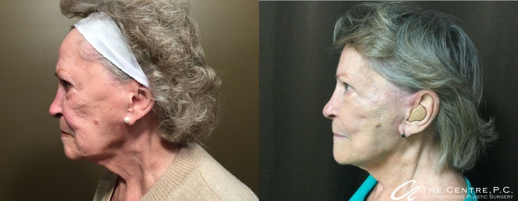Before and after Facelift case 9965 - Angle 3