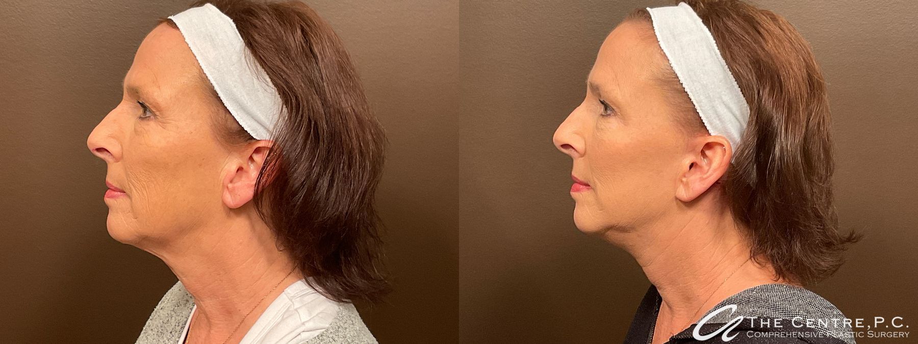 Before and after Featured Cases case 13975 - Angle 2