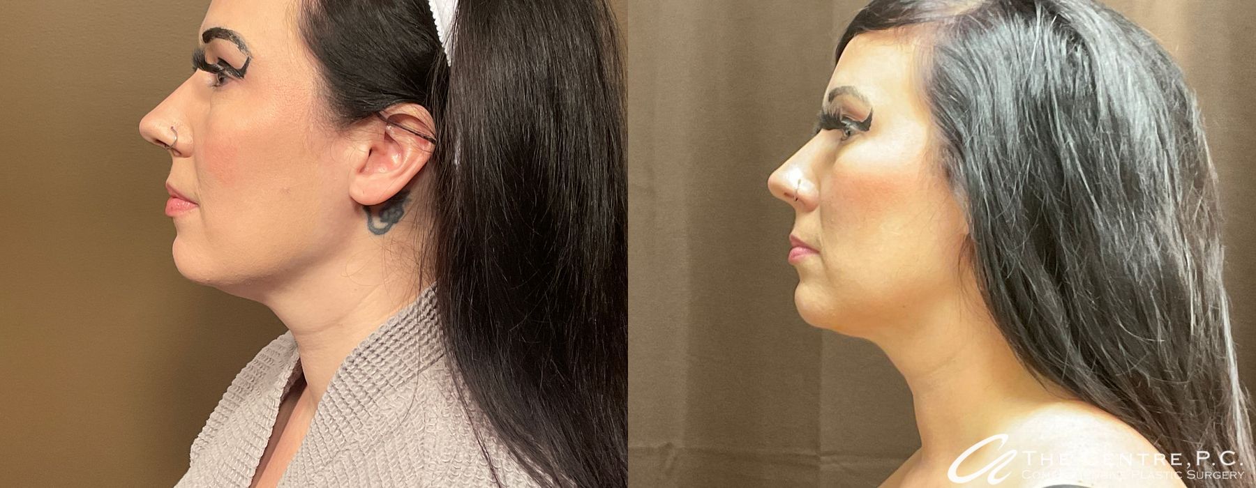 Before and after Facetite case 13130 - Angle 3