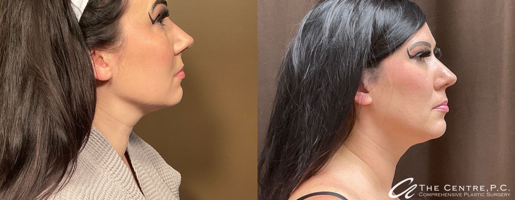 Before and after Facetite case 13130 - Angle 2