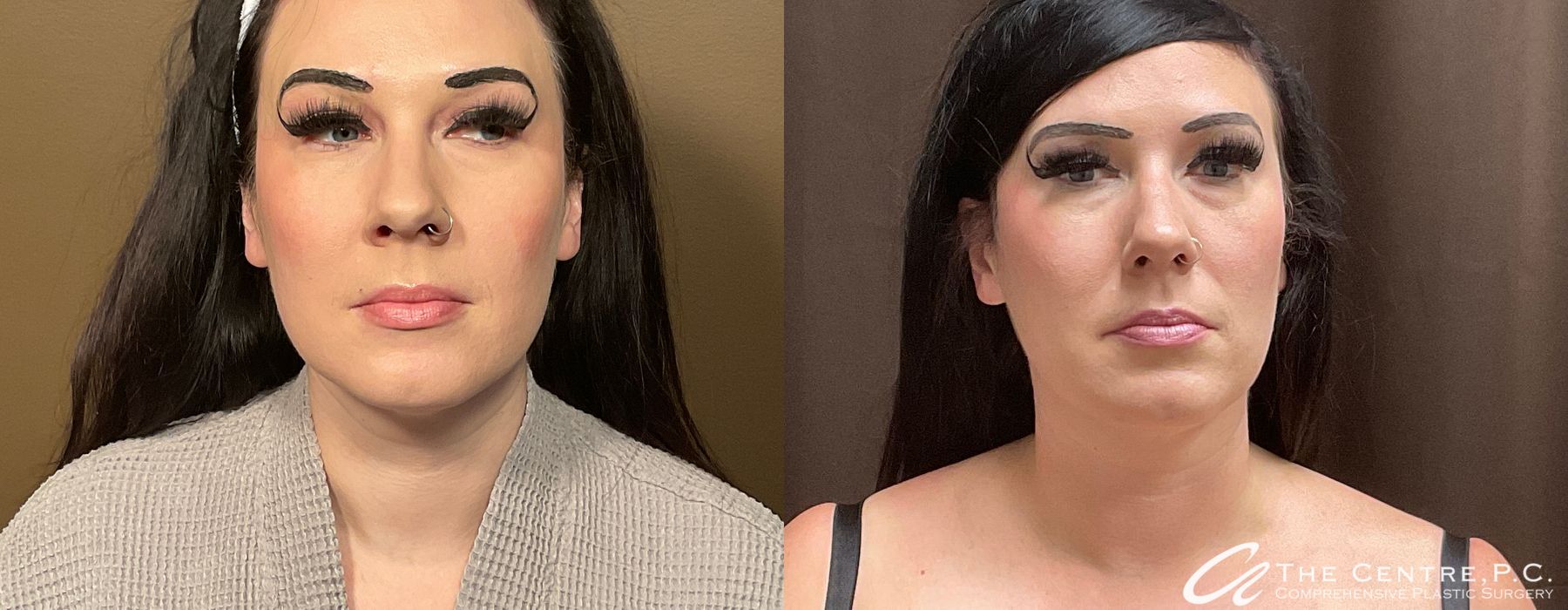 Before and after Facetite case 13130