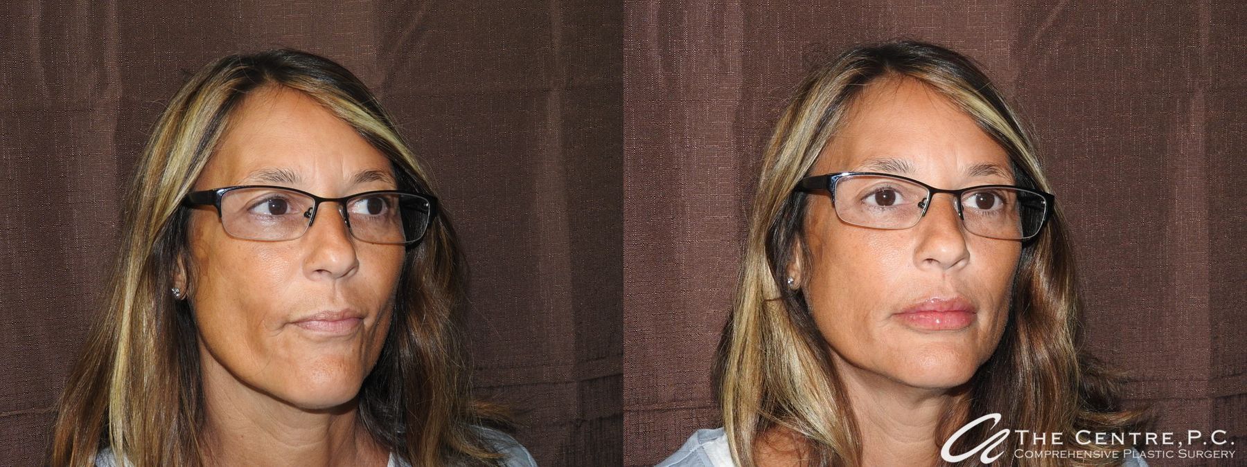 Before and after Fillers case 19901 - Angle 5