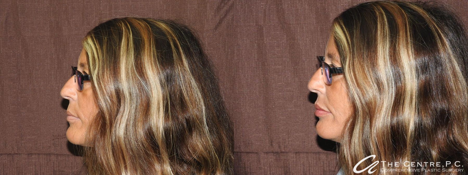 Before and after Fillers case 19901 - Angle 3