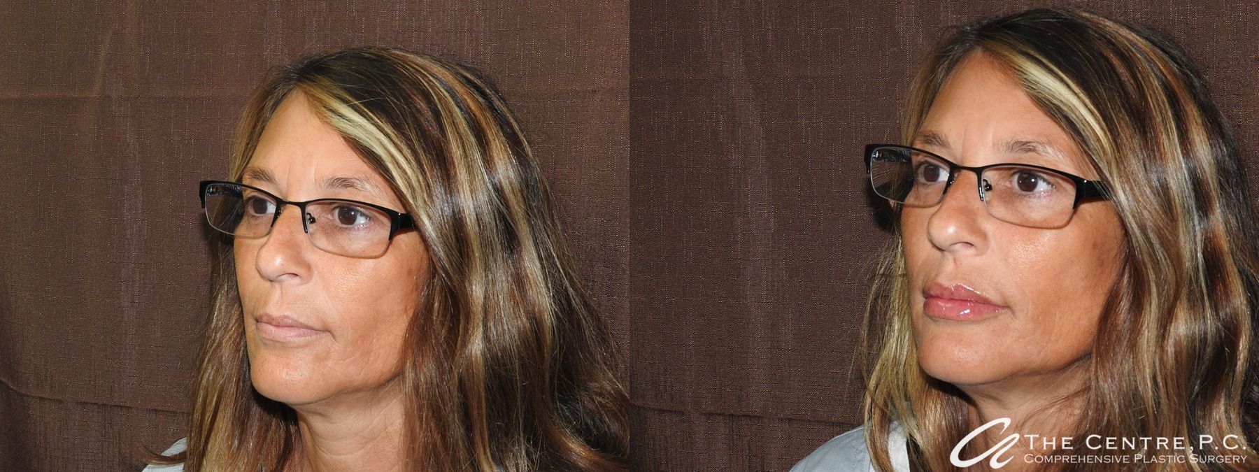 Before and after Fillers case 19901 - Angle 4