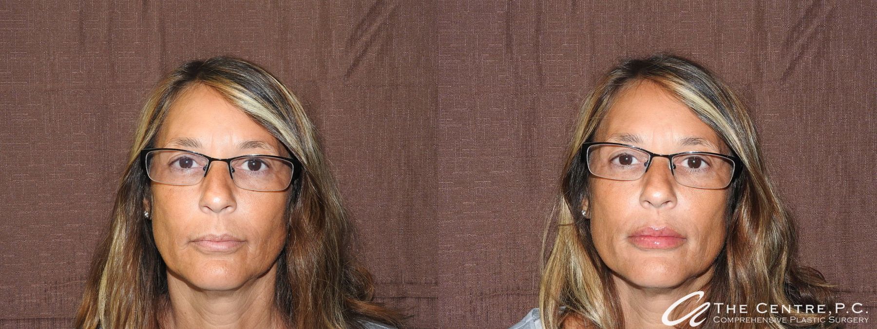 Before and after Fillers case 19901