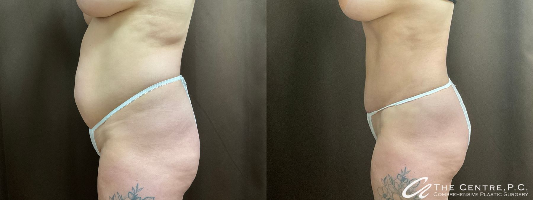Before and after Tummy Tuck case 50306 - Angle 2