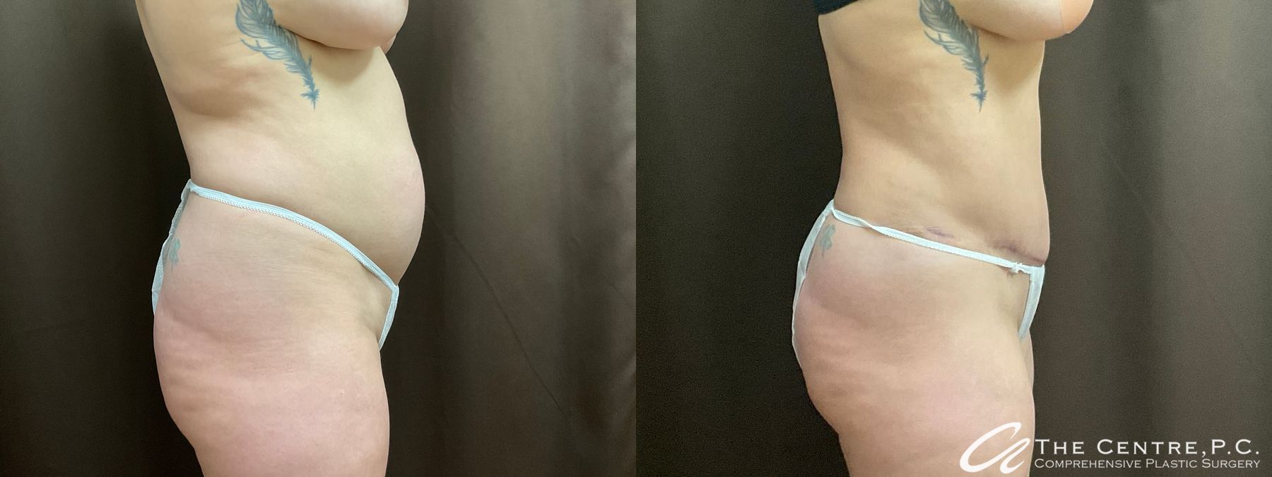 Before and after Tummy Tuck case 50306 - Angle 3