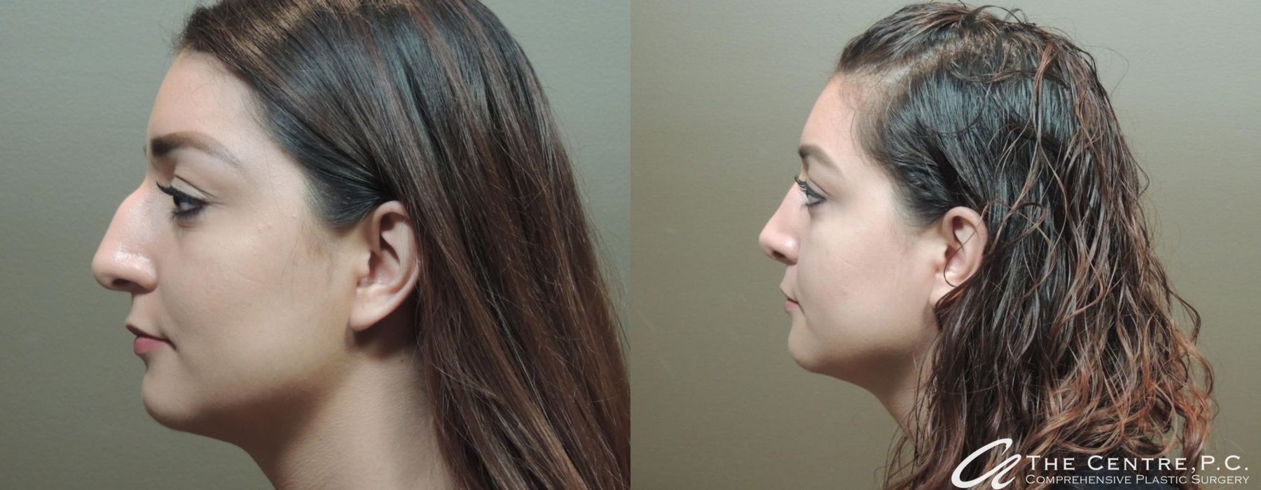 Before and after Rhinoplasty case 9956 - Angle 3