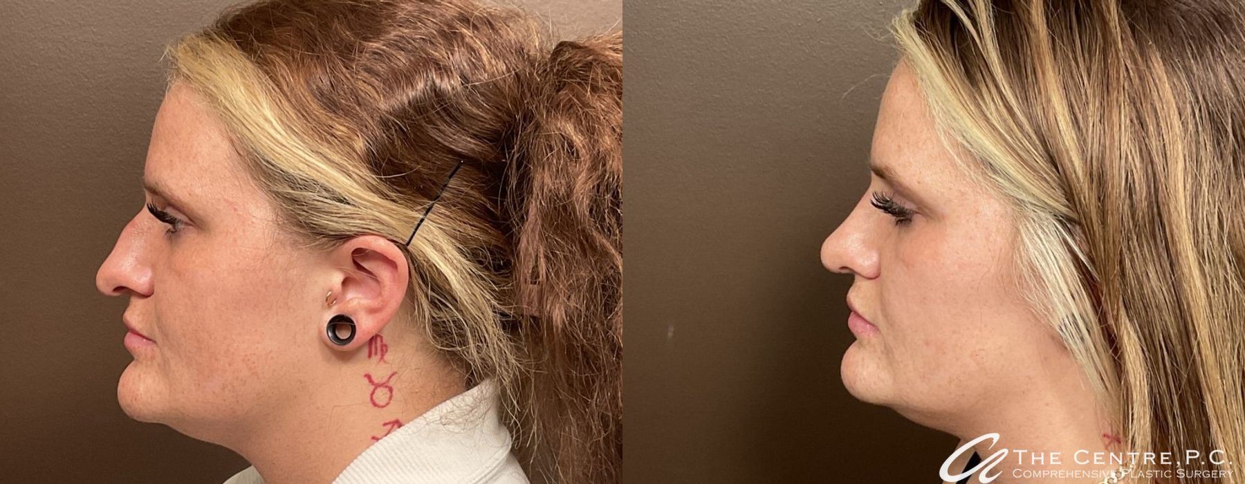 Before and after Rhinoplasty case 9953 - Angle 2