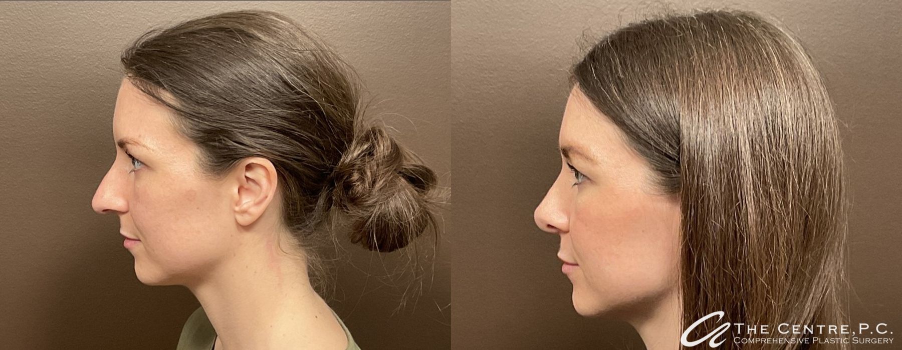 Before and after Featured Cases case 9966 - Angle 3