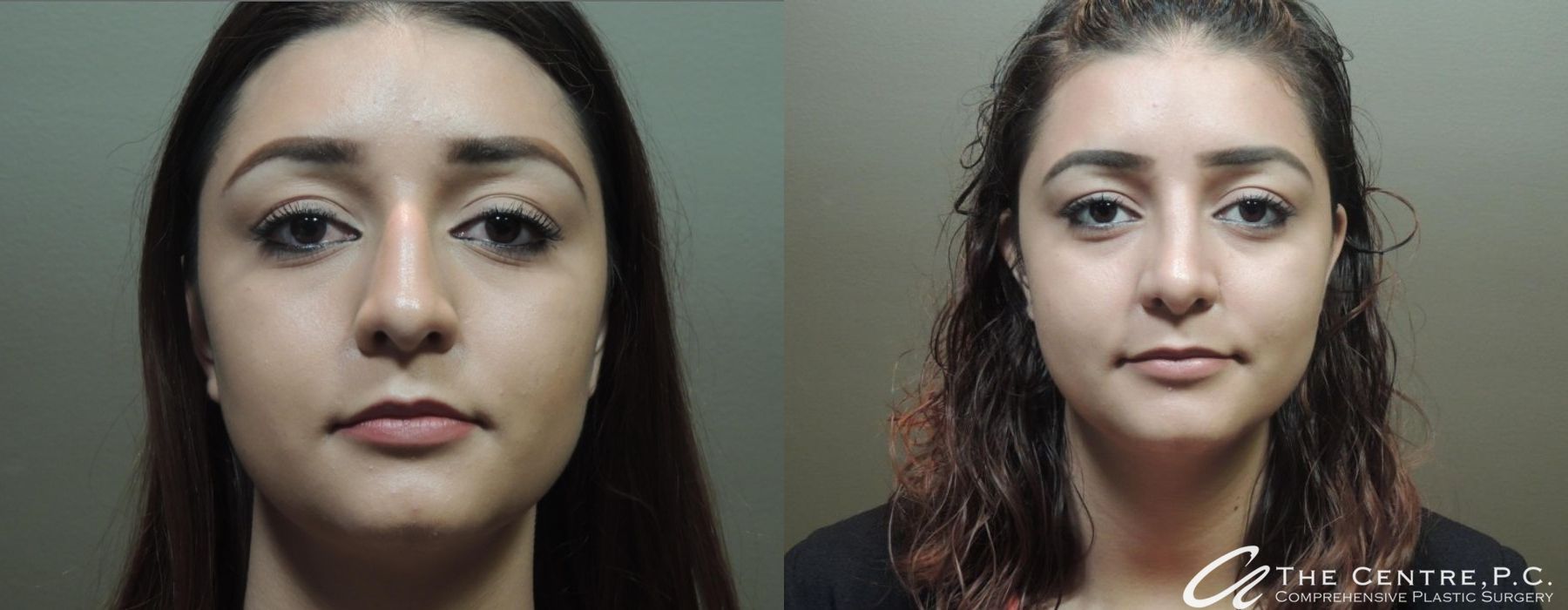 Before and after Rhinoplasty case 9956