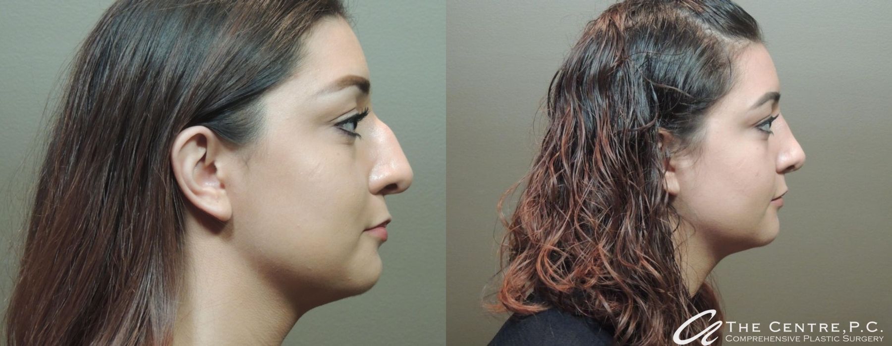 Before and after Rhinoplasty case 9956 - Angle 2