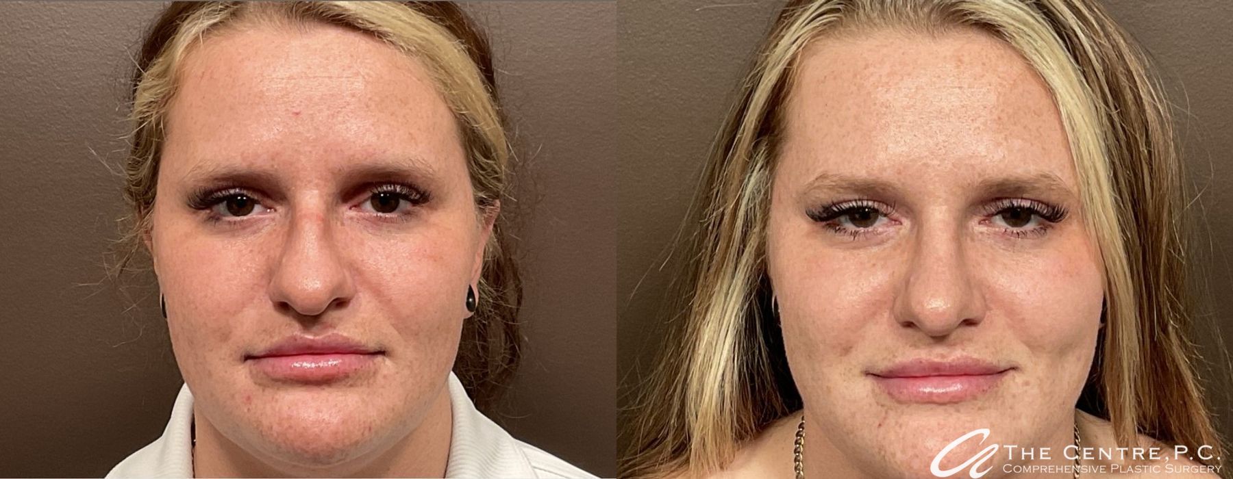 Before and after Rhinoplasty case 9953