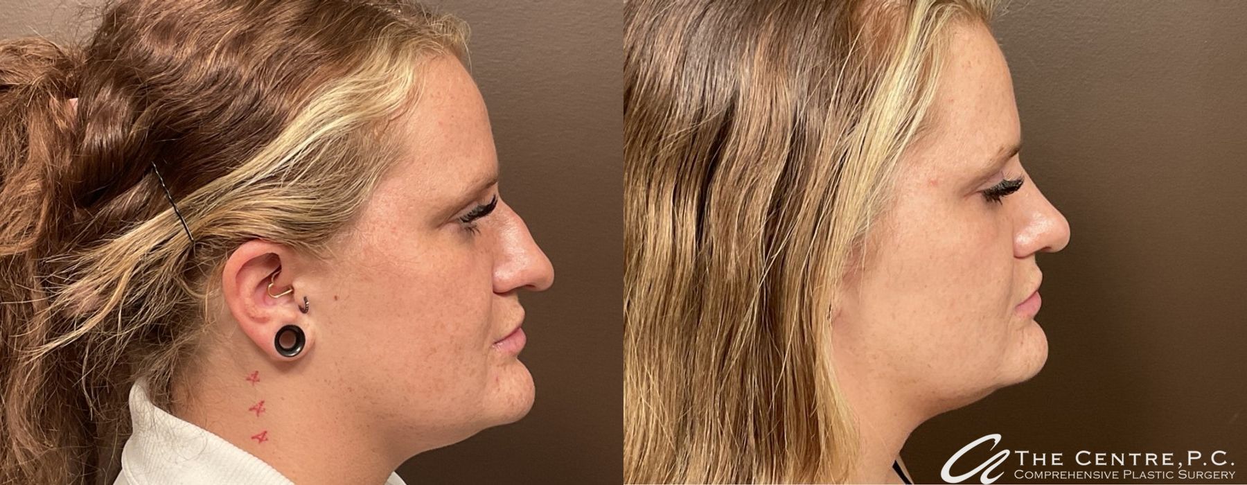 Before and after Rhinoplasty case 9953 - Angle 3