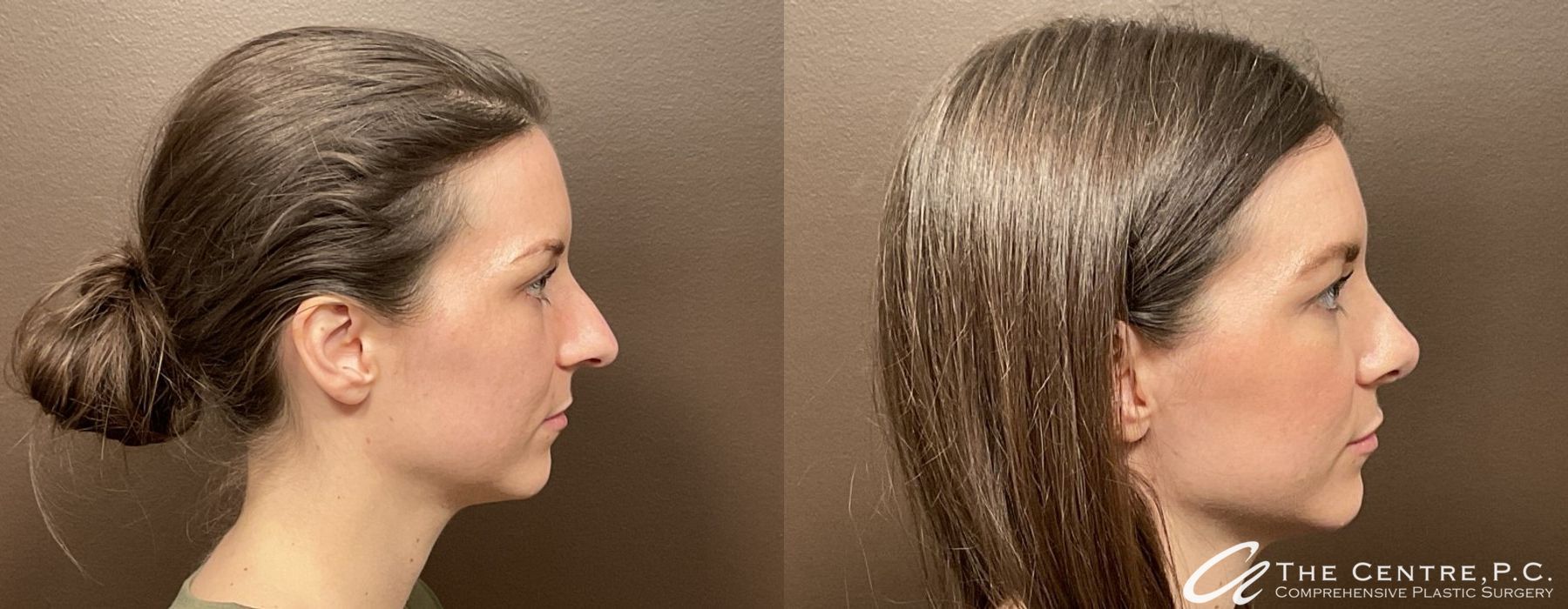 Before and after Featured Cases case 9966 - Angle 2