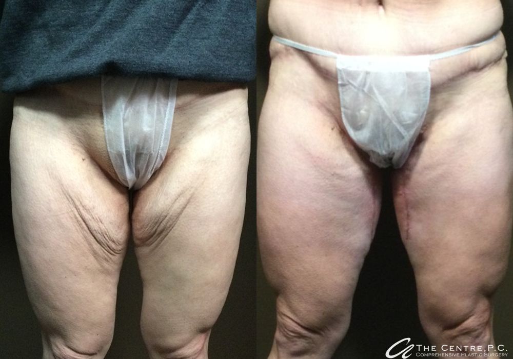 Before and after procedure result