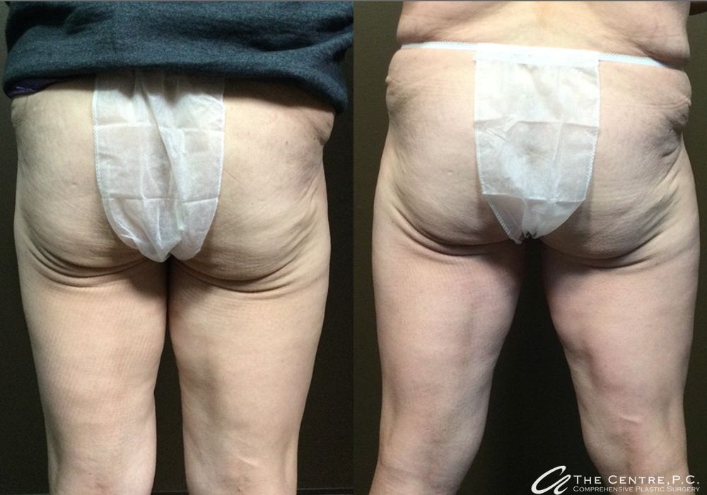 Before and after Thigh Lift case 11882 - Angle 2