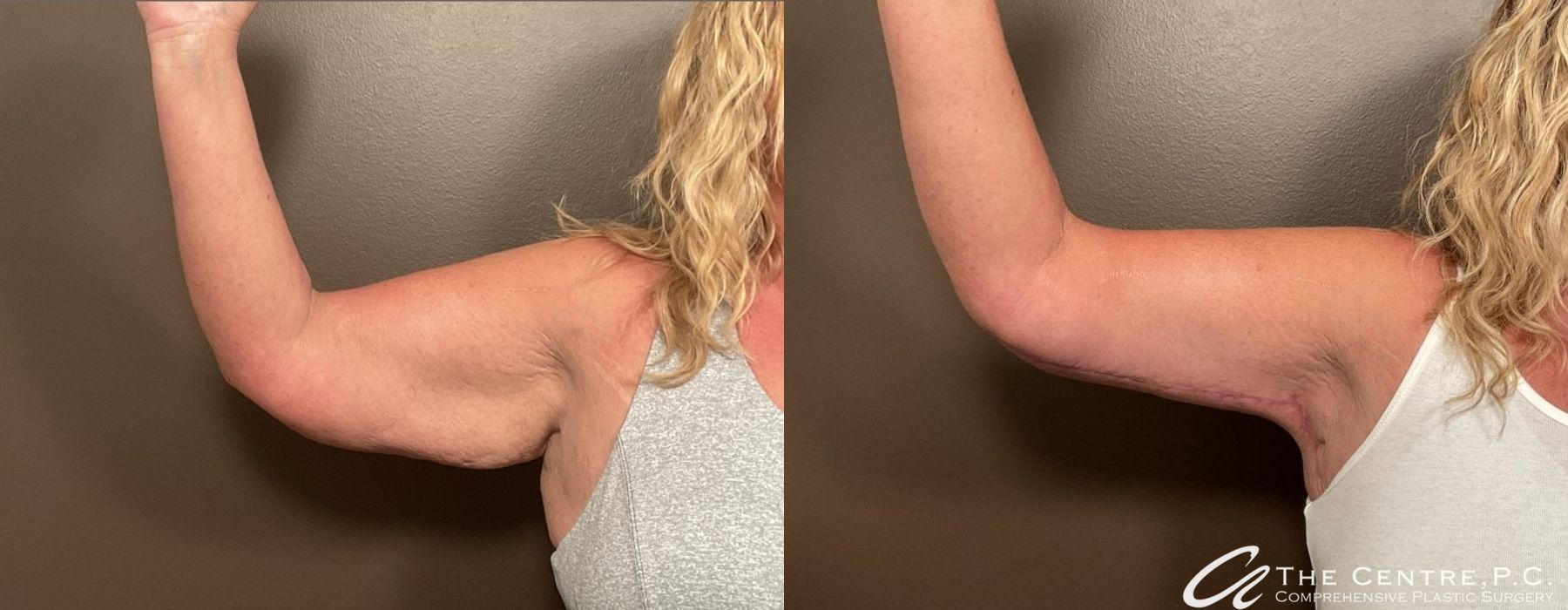 Brachioplasty - Thumbnail 3