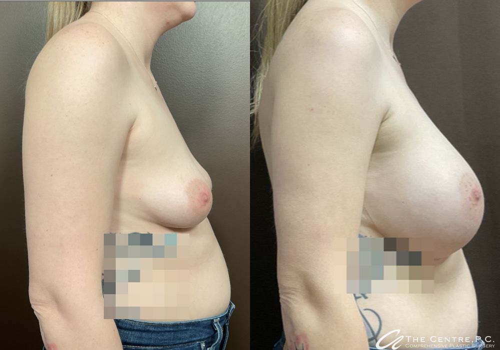 Breast Augmentation - Thumbnail 3