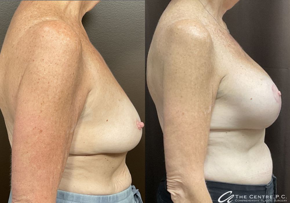 Before and after Breast Augmentation with Lift case 11815 - Angle 2