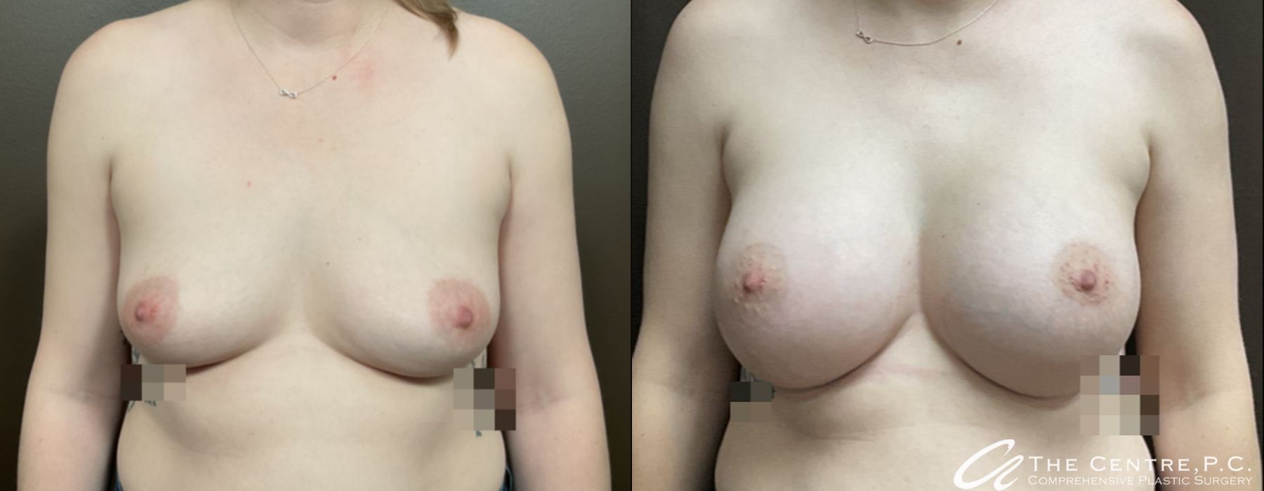 Breast Augmentation - Case 3328