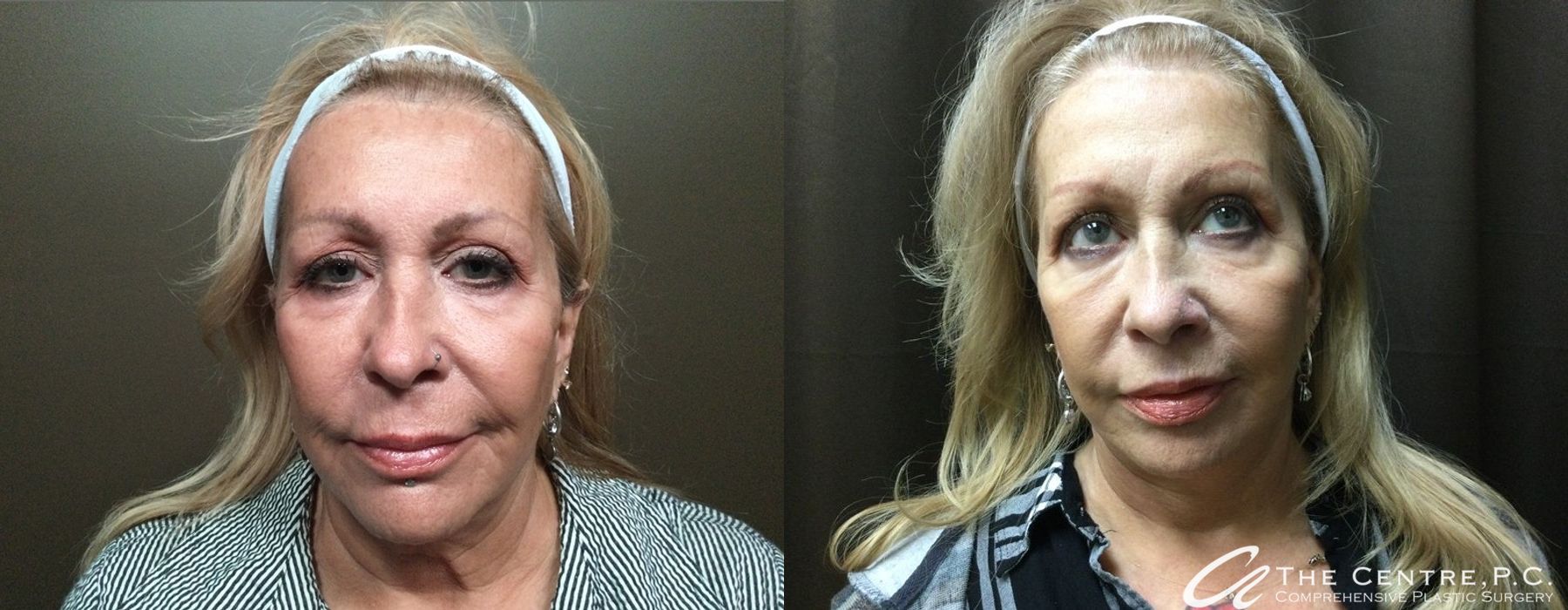 Before and after Facelift case 9954