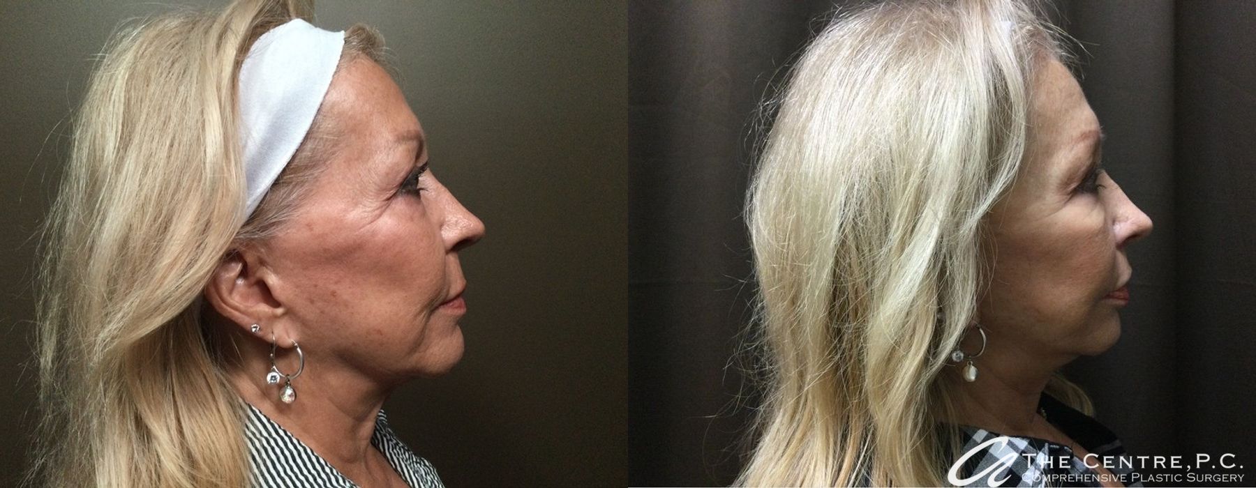Before and after Facelift case 9954 - Angle 3