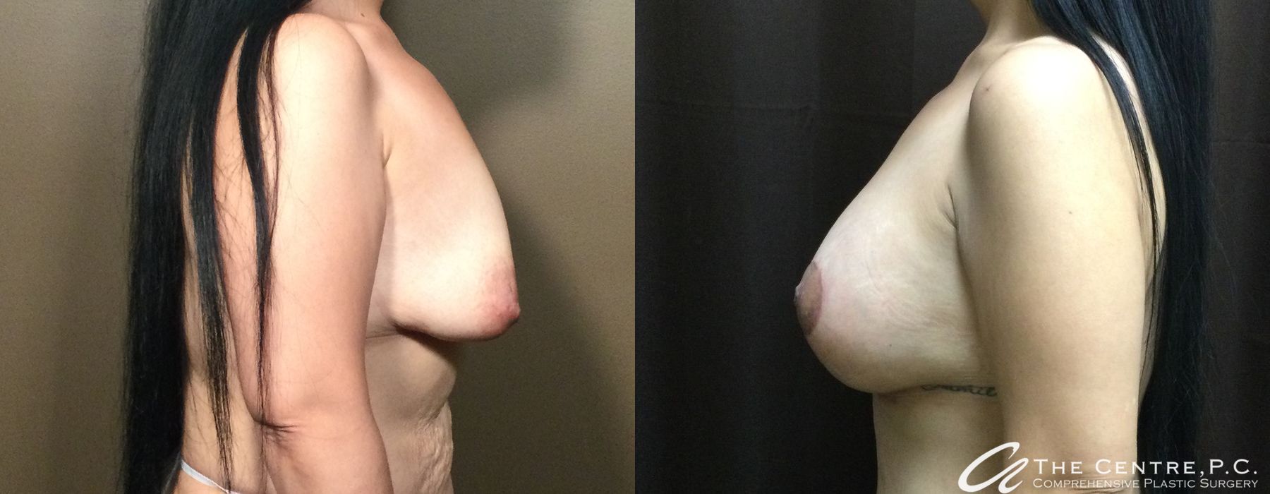 Before and after Breast Augmentation with Lift case 12950 - Angle 2