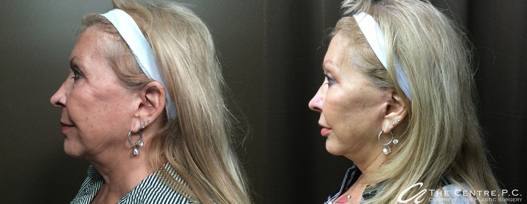 Before and after Facelift case 9954 - Angle 2