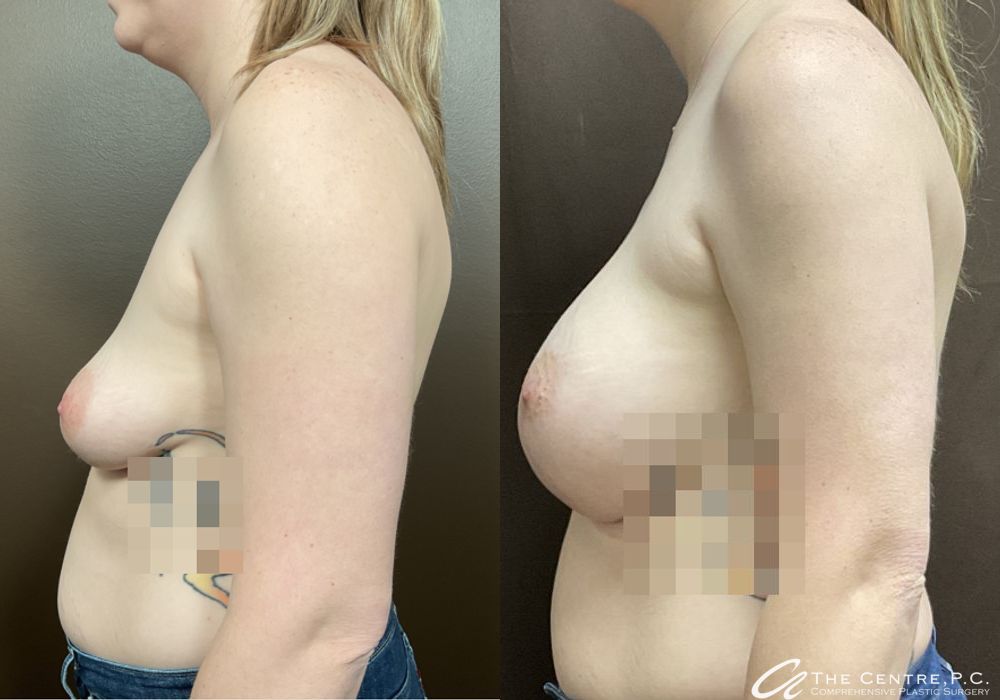 Breast Augmentation - Thumbnail 2