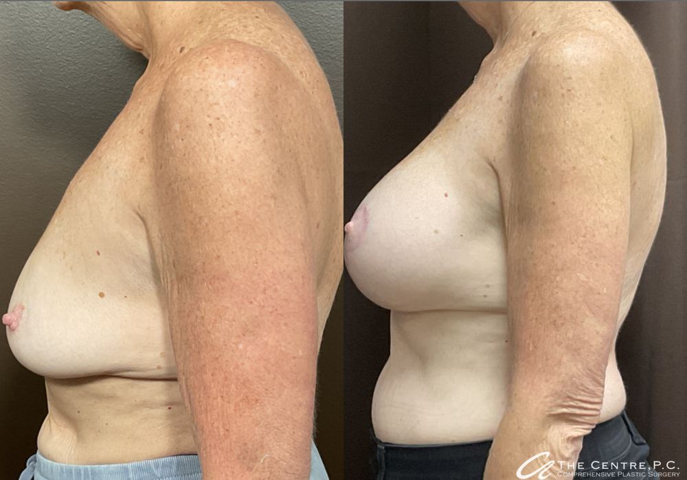 Before and after Breast Augmentation with Lift case 11815 - Angle 3