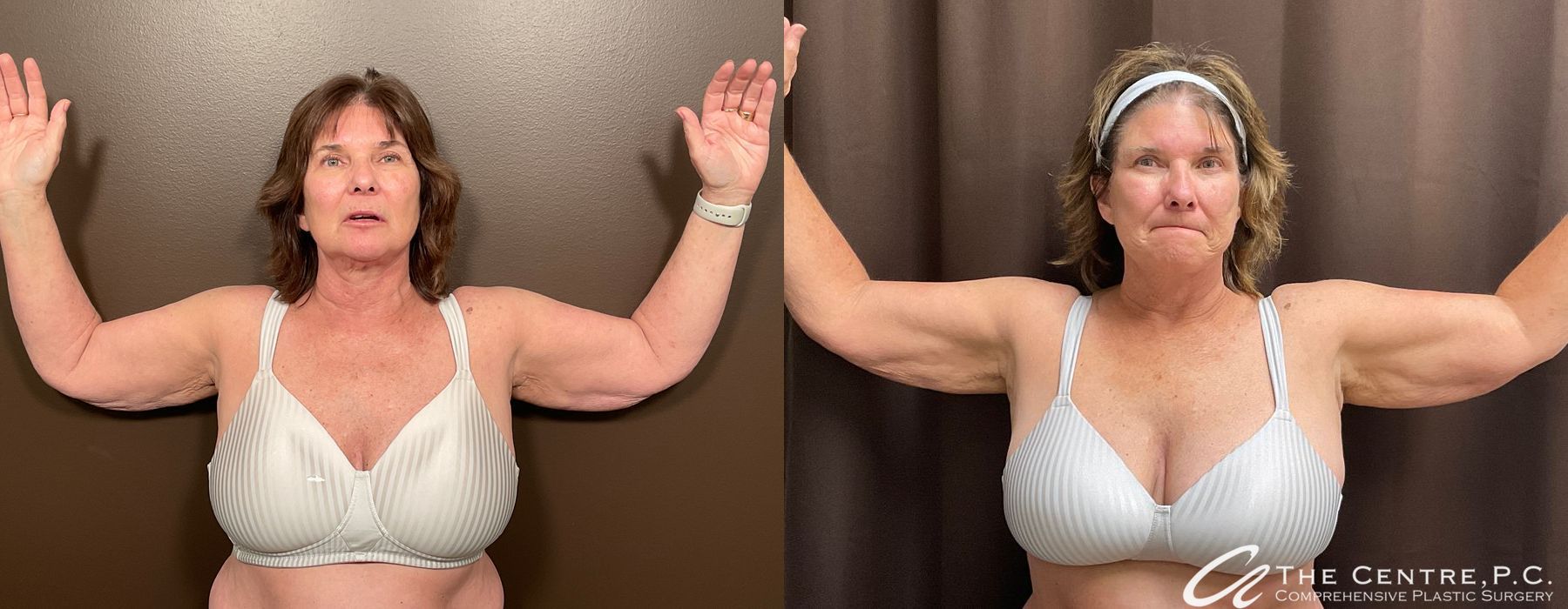 Arm Lift - Thumbnail 2