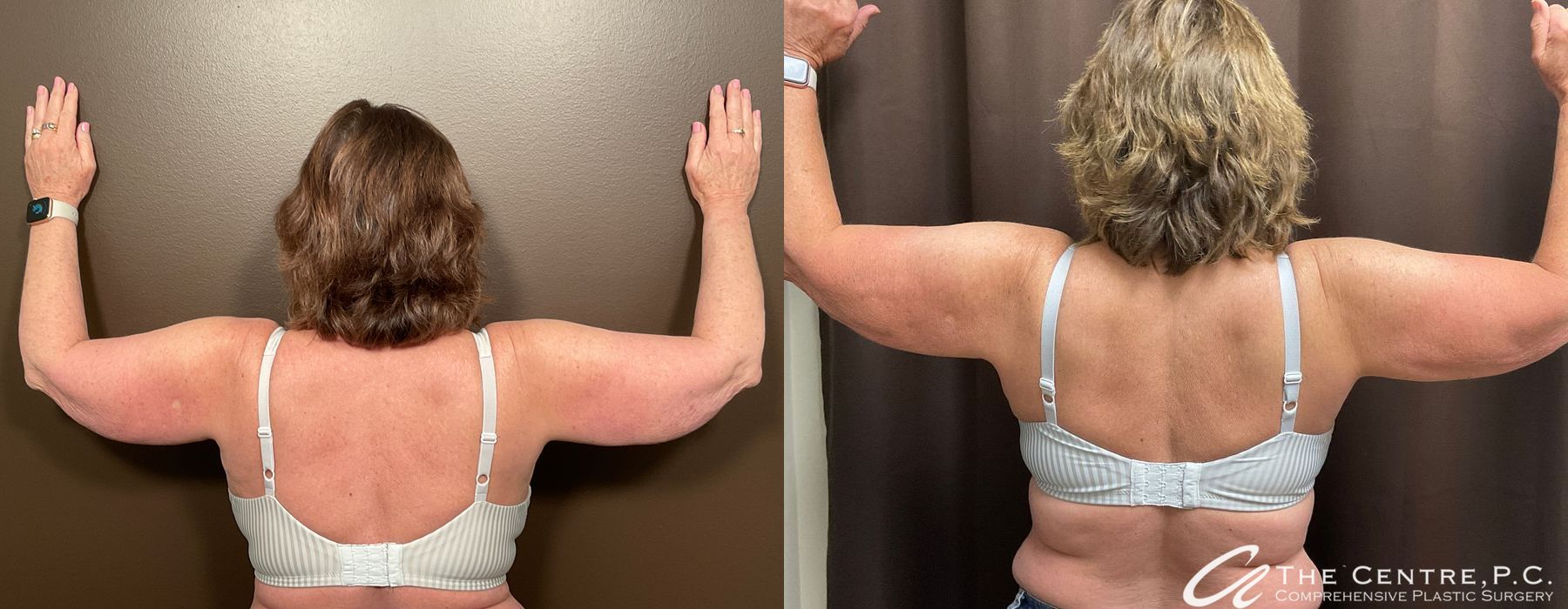 Arm Lift - Case 3258