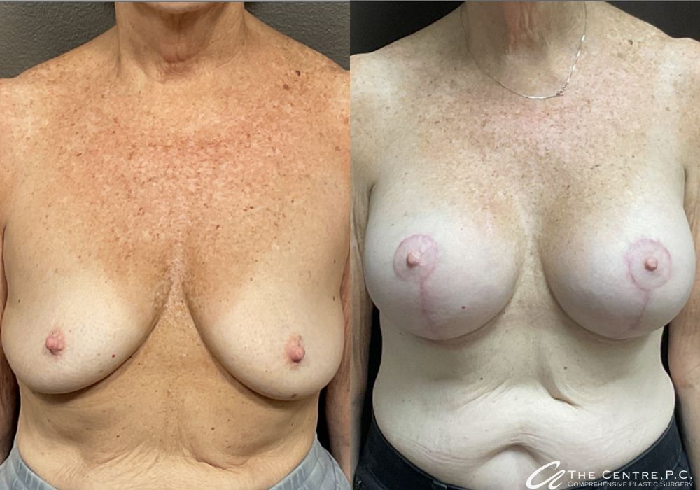 Before and after procedure result