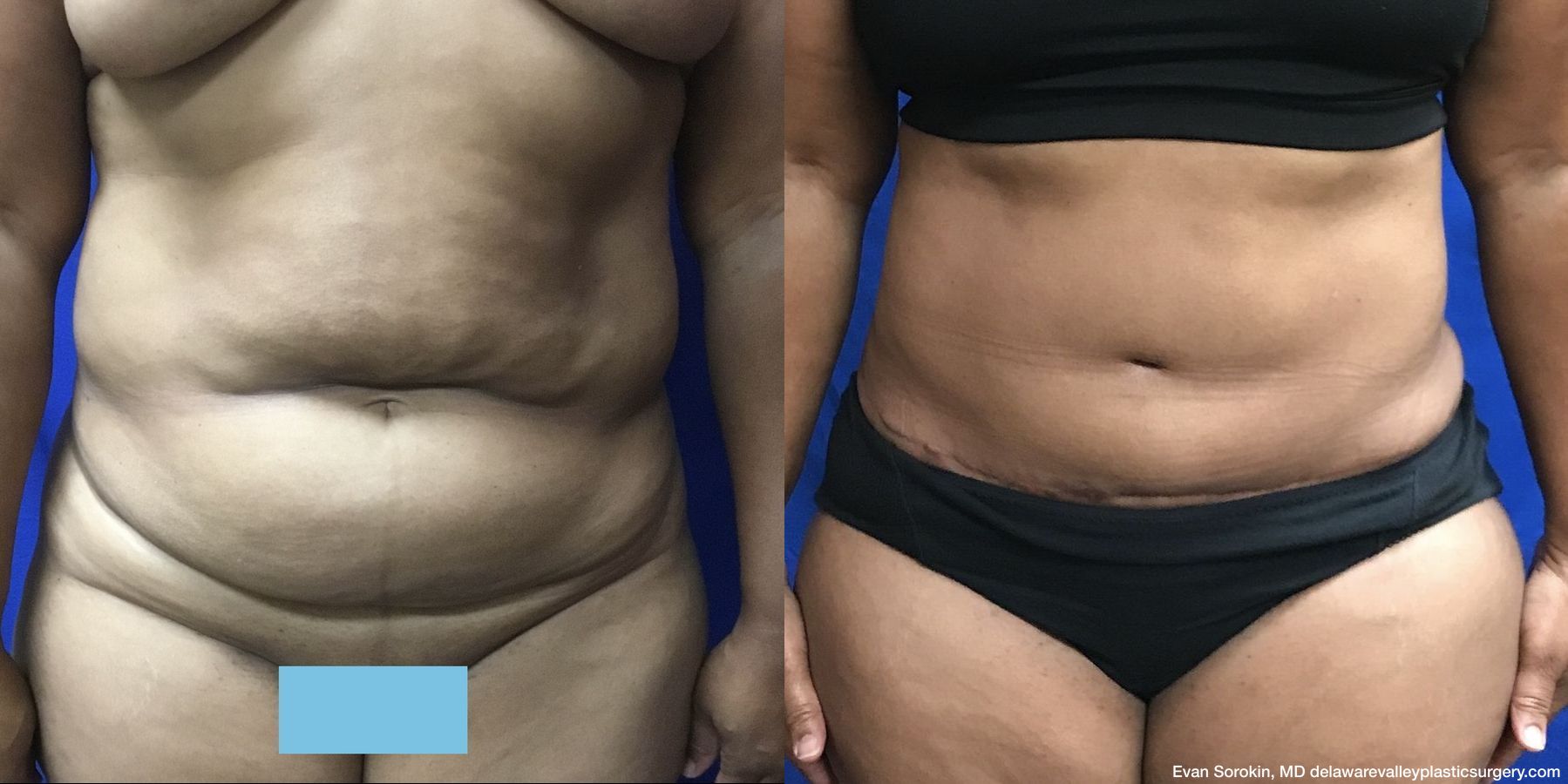 Abdominoplasty - Case 1488830