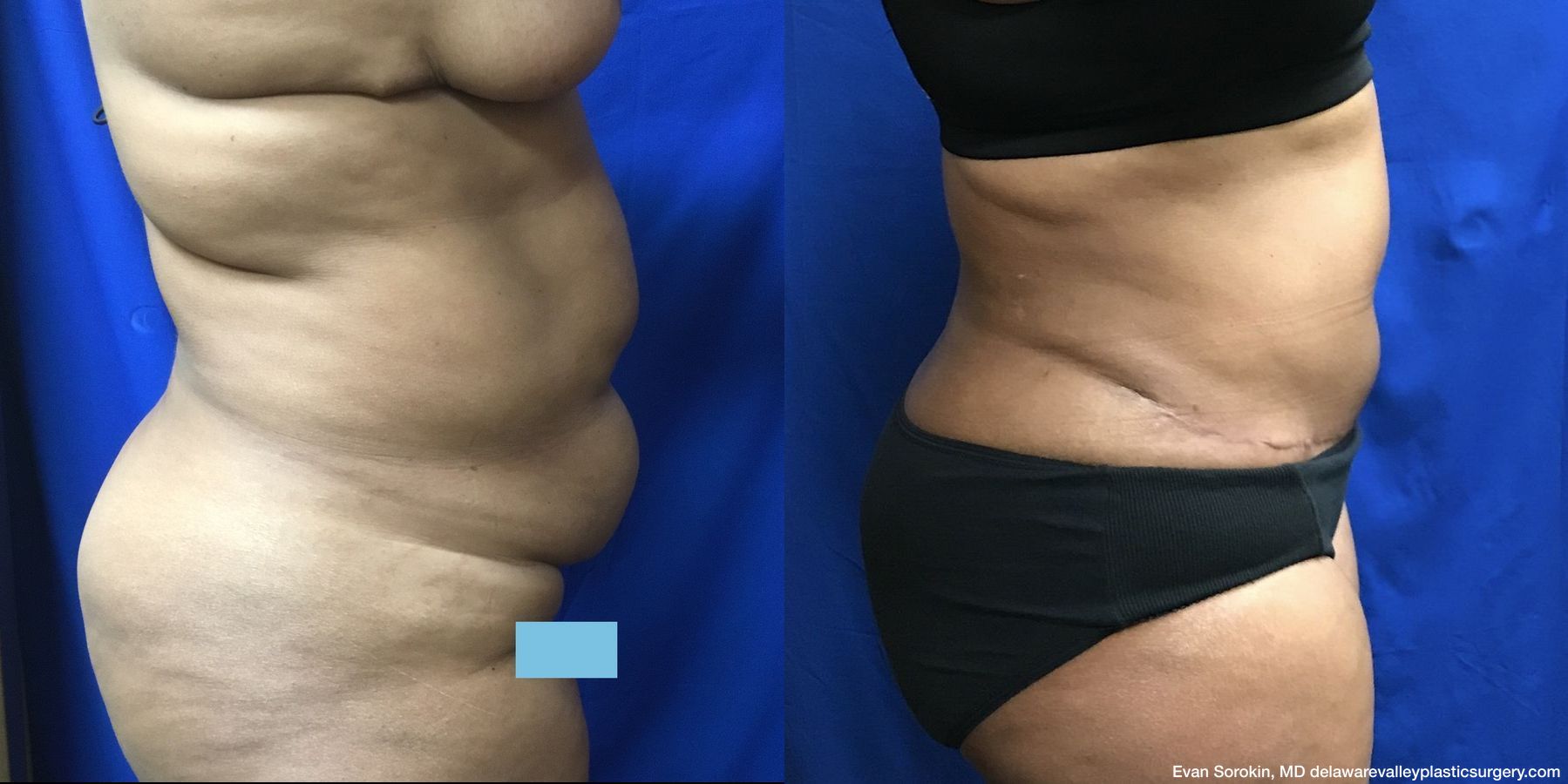 Abdominoplasty - Thumbnail 3