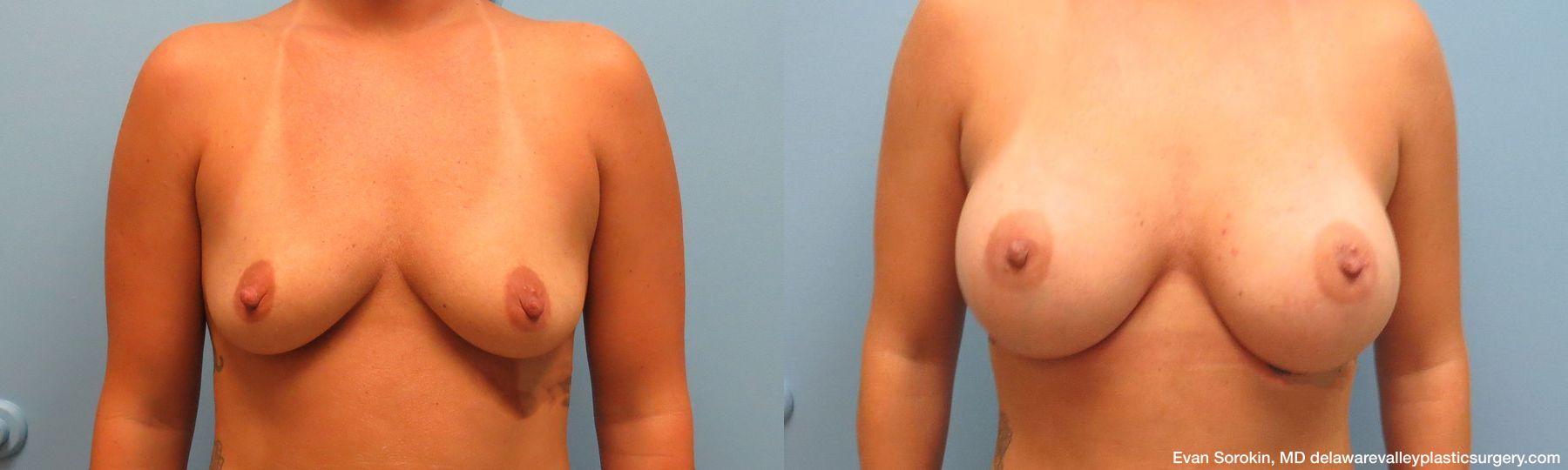 Breast Augmentation - Case 1489114