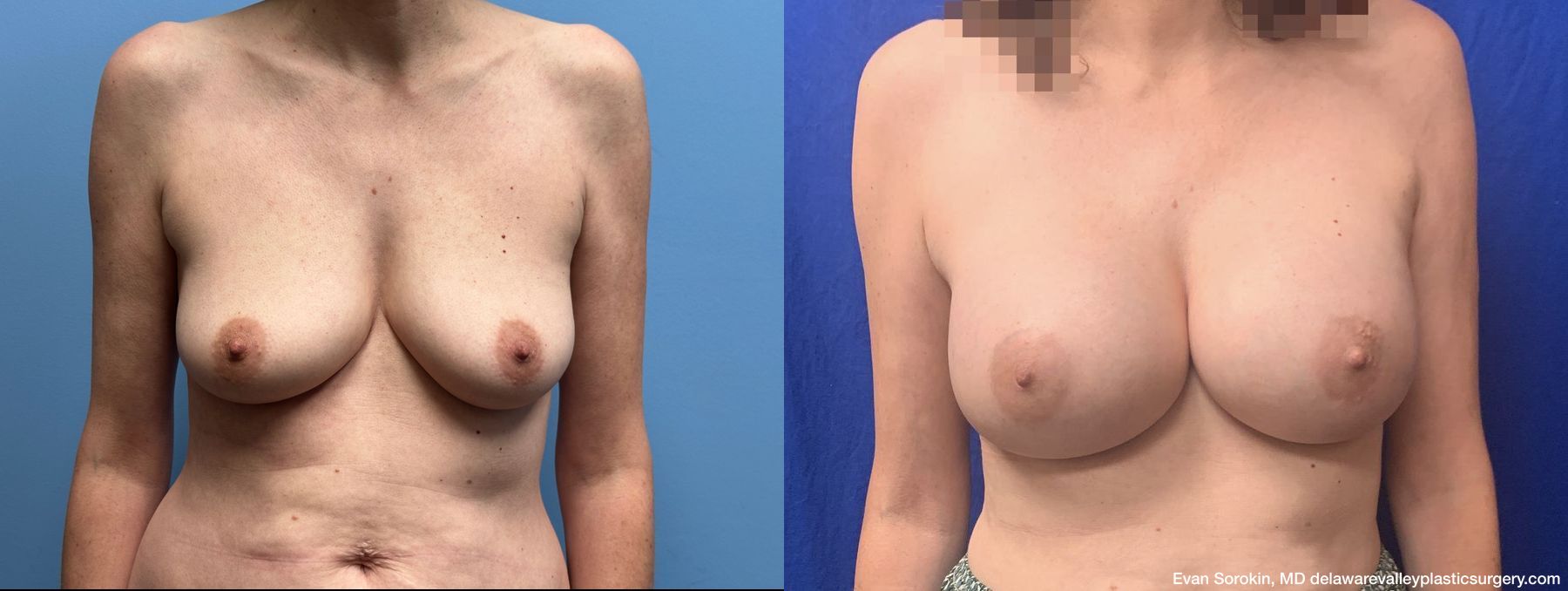 Breast Augmentation - Case 1488907