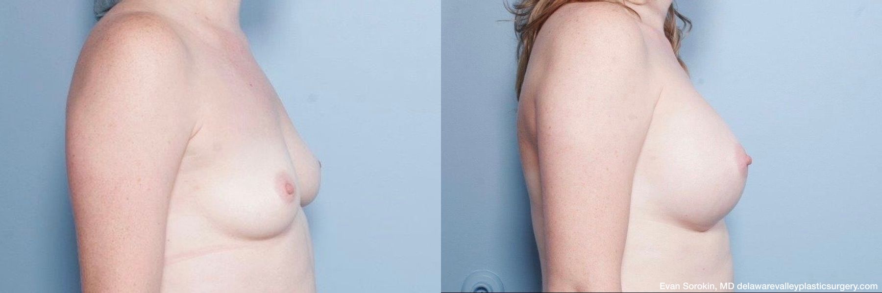 Breast Augmentation - Thumbnail 4