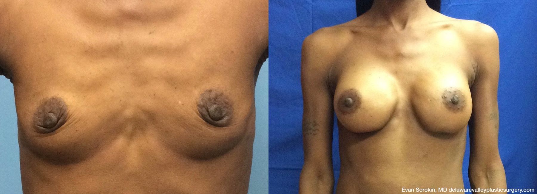 Breast Augmentation - Case 1489059