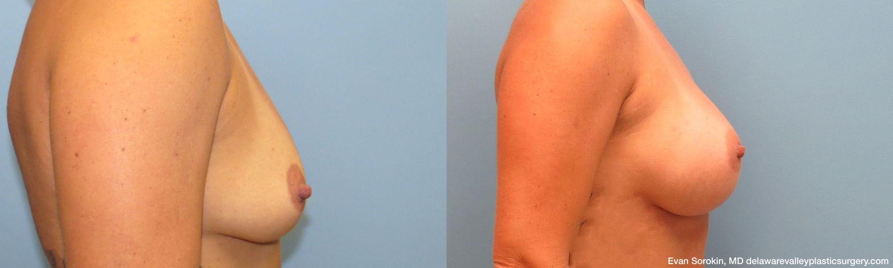 Breast Augmentation - Thumbnail 3