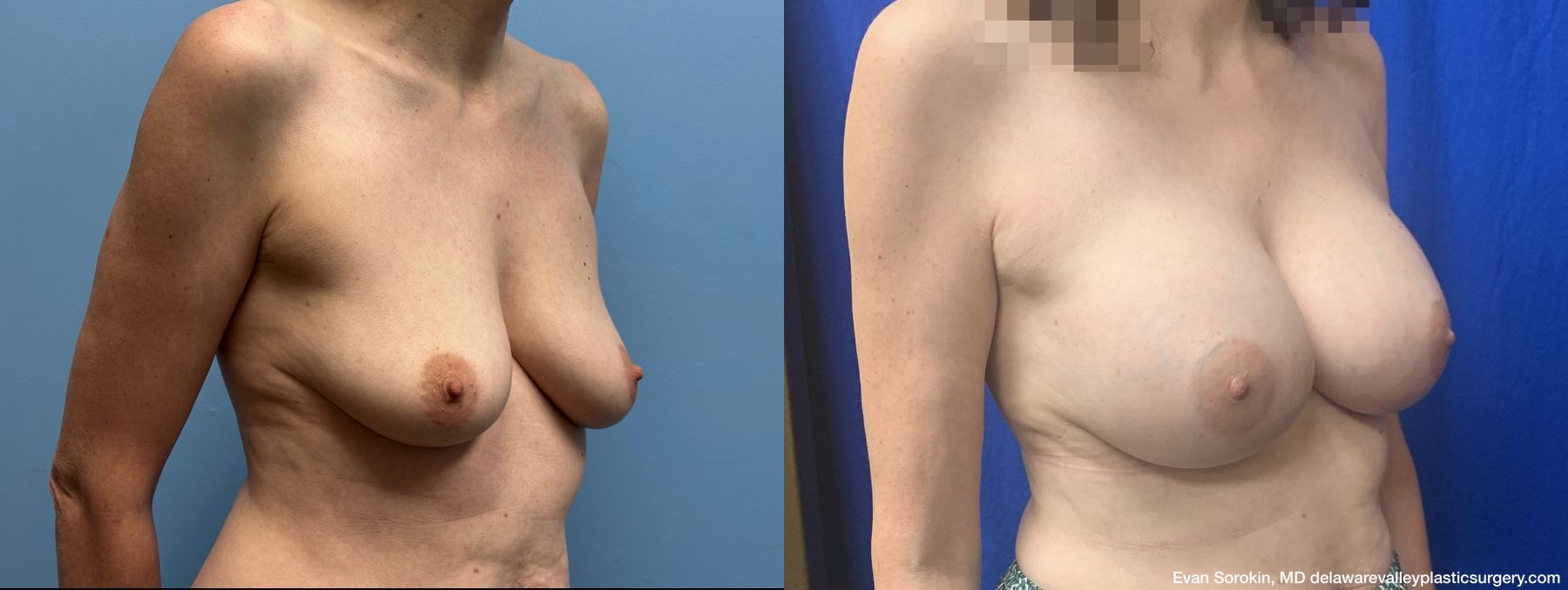 Breast Augmentation - Thumbnail 2