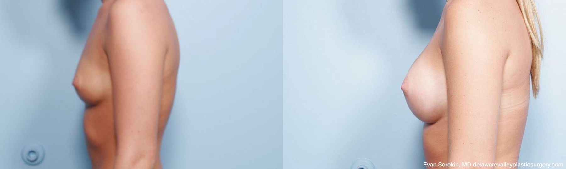 Breast Augmentation - Thumbnail 5