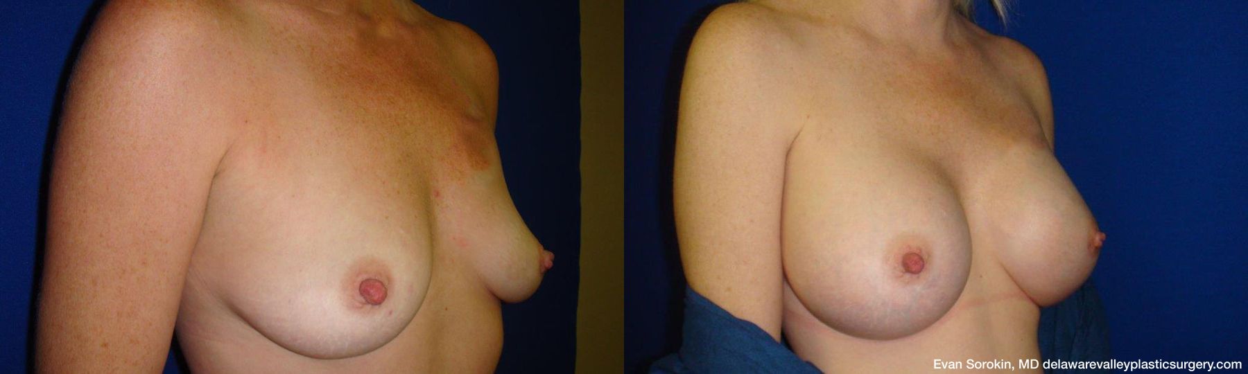 Breast Augmentation - Thumbnail 2